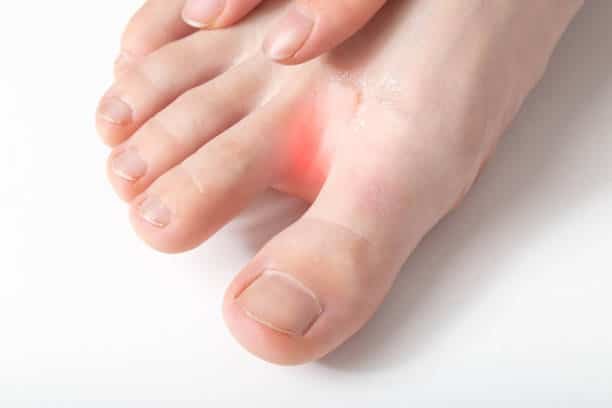 Best Antifungal Creams in the Philippines